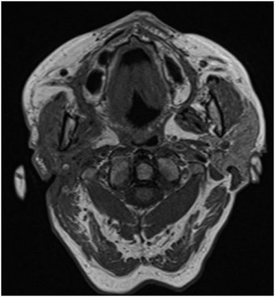 The 81-year-old woman's head and neck MRI showed no signs of malignancy.