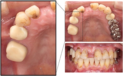 Intraoral images of the 70-year-old woman. Clinicians replaced the bridge on her upper right molars with individual temporary crowns. All images courtesy of Watanabe et al. Licensed under CC BY 4.0.
