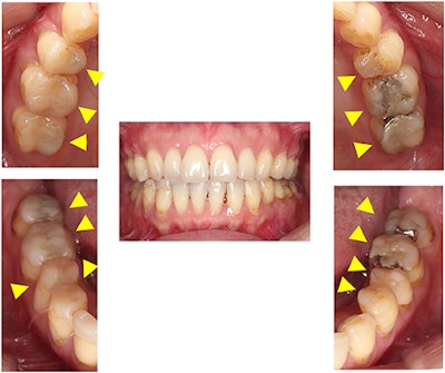 Intraoral images of the 48-year-old woman. All of the patient's teeth were in contact, but clinicians constructed dental composite resins on almost every lower tooth surface for occlusal adjustment after orthodontic treatment.