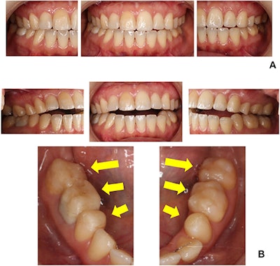 Intraoral images of the 38-year-old woman during her first visit (A) and revisit (B). Dental composite resin was constructed on her molars according to her demands. An anterior open bite can also be seen.