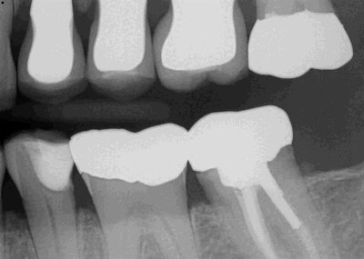 Preop radiograph of tooth #20. All images courtesy of Dr. Matthew Burton.