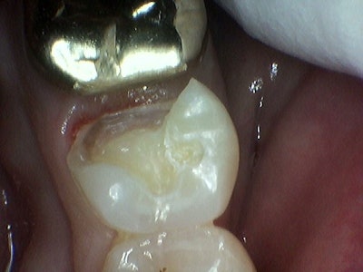 Failing composite restoration and decay were removed.