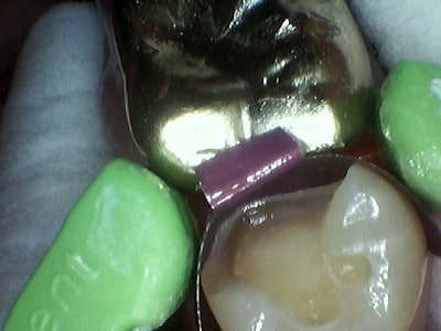 Triodent Ring is placed over the sectional matrix and in between the split wings of VursaWedge.