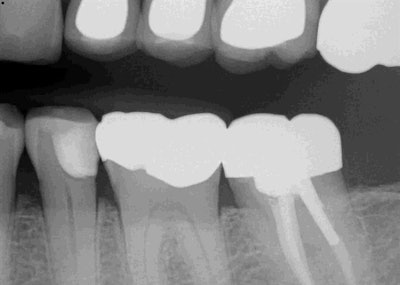 Postop radiograph of #20 confirms gingival margin.