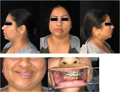 A composite of the patient, showing significant facial asymmetry and malocclusion prior to surgery. All images courtesy of Vajda et al. Licensed under CC BY 4.0.