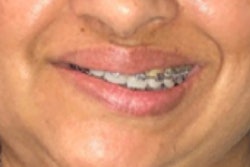 2021 08 13 21 51 3194 2021 08 16 Condylar Resorption1 Thumb