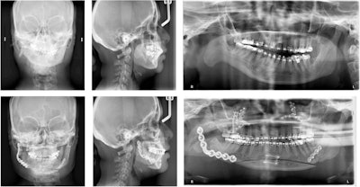 The patient's presurgery cephalometric radiograph.