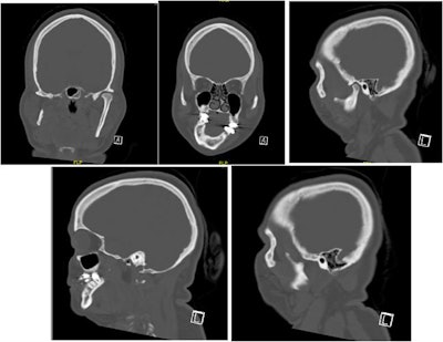 Selected computed tomography (CT) scan slices show mandibular and maxillary hypoplasia and condylar resorption on the right side.