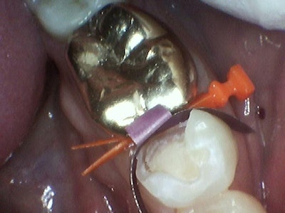 VursaWedge with split wings on the lingual portion of the box.