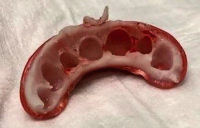 Fitting surface of the novelty teeth after they were removed from the patient's mouth. All images courtesy of Wilson et. al. Licensed under CC BY 4.0.