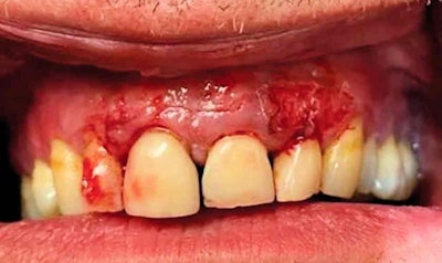 The patient's mouth after the novelty teeth were removed.