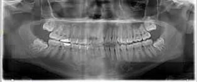 A panoramic radiograph shows the restoration of tooth #3 with periapical radiolucency and right maxillary sinusitis.