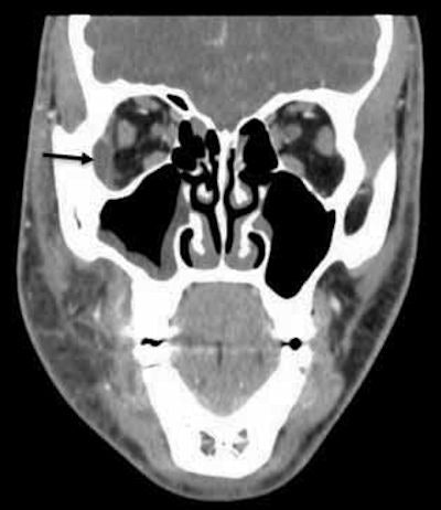 A CT scan (coronal section) shows the patient's right lateral orbit subperiosteal abscess, identified by a black arrow, and right maxillary sinusitis. All images courtesy of Houle et al. Licensed under CC BY 4.0.