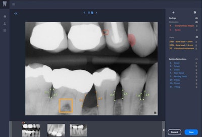 Overjet's software displays a radiograph with dental artificial intelligence findings. Image courtesy of Overjet.