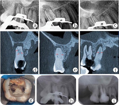 X-ray of tooth #17 shows (A) mesiobuccal, (B) distobuccal, and (C) palatal roots. A CBCT scan shows canal configuration in the (D) mesiobuccal root, (E) distobuccal root, and (F) palatal root canals. (G) Image of root canal orifices. (H) Image of master cone fit. (I) Postobturation radiograph.