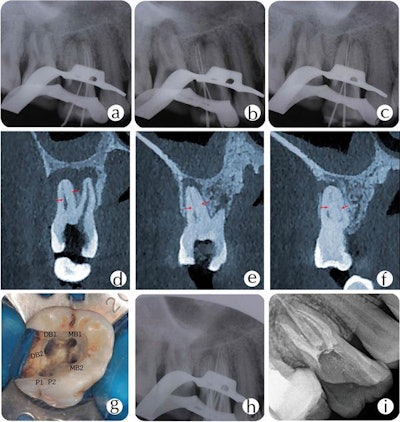 X-ray of tooth #16 shows (A) mesiobuccal, (B) distobuccal, and (C) palatal roots. A CBCT scan shows canal configuration in the (D) mesiobuccal root, (E) distobuccal root, and (F) palatal root canals. (G) Image of access opening showing six root canal orifices. (H) Image of master cone fit. (I) Postobturation radiograph. All images courtesy of Lin, Xiang, et al. Licensed under CC BY 4.0.