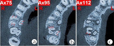 CBCT shows the (A) six root canals of tooth #16 and three mesiobuccal root canals, (B) two palatal root canals of tooth #17, and (C) two distobuccal root canals of tooth #17.