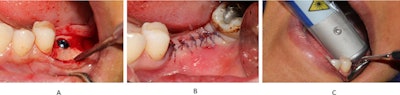(A) Implant insertion, (B) flap suturing, and (C) laser therapy on lingual side. Image courtesy of Reza et al and J Photochem Photobiol. Licensed under CC BY-NC-ND 4.0.