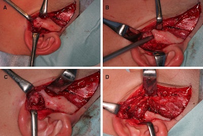 Above: Intraoperative photos demonstrating a bony fusion between the condylar head and glenoid fossa (A), the use of the navigation system to confirm the operating position (B), the formed articular cavity (C), and the temporal muscle insertion into the joint space created by the surgery (D). Below: Display of the Medtronic StealthStation S7 workstation. All images courtesy of Miyazaki et al. Licensed under CC BY 4.0.