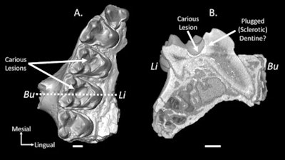 (A) A micro-CT reconstruction of the right upper jaw fragment of M. latidens with carious lesions on the first and second molars. (B) A reconstruction of a slice through the caries in the second molar showing the internal morphology of the carious lesion. The slice is demarcated by the dashed line. All images courtesy of Selig et al. Licensed under CC BY 4.0.