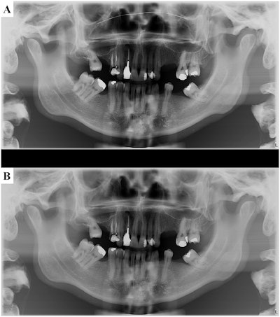 Panoramic radiographs of an anthropomorphic phantom covered with a soft-tissue simulator (Mix-D) acquired with the use of a face mask with a nose wire (A) and one without a nose wire (B). Image courtesy of Academic Radiology.