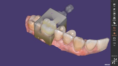 Exocad's ChairsideCAD 3.0 Galway CAD software is designed for single-visit dentistry with streamlined workflow. Image courtesy of Exocad.