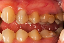 2017 07 07 13 34 02 577 Teeth Periodontal Disease 400