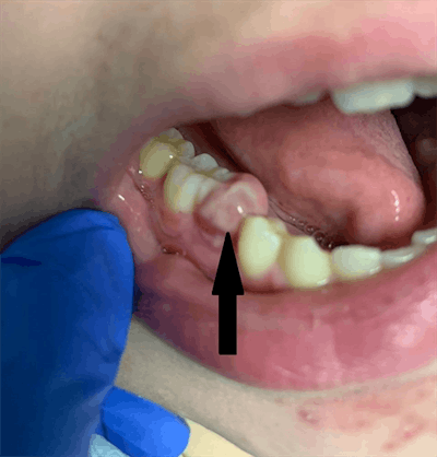 An oral exam showed gingival swelling. Images courtesy of Kahlon et al. Licensed under CC BY 4.0.