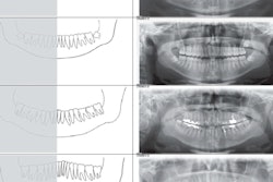 2021 10 18 21 43 5704 2021 10 19 Bone Apposition Grades 400thumb
