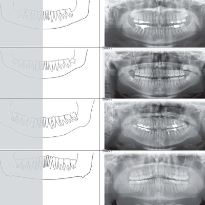 2021 10 18 21 43 5704 2021 10 19 Bone Apposition Grades 400thumb