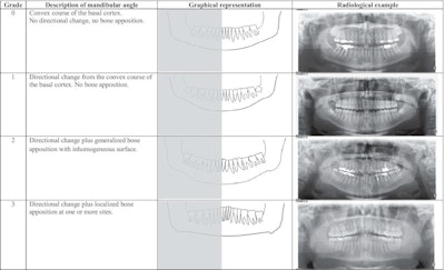 Radiological Example Of Bone Apposition At The Mandibular Angle