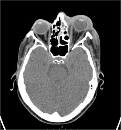 An axial CT scan shows significant preseptal swelling and post septal/retro-orbital fat stranding with small volume fluid at the lateral and superior left orbit. There was considerable protrusion of the left eye, as well as anterior ethmoid cell opacification. Images courtesy of Ghasemi, et al. Licensed under CC BY 4.0.