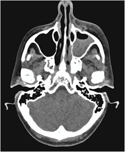 An axial CT scan shows opacification of the woman's left maxillary sinus with marked soft tissue swelling of her left infraorbital.