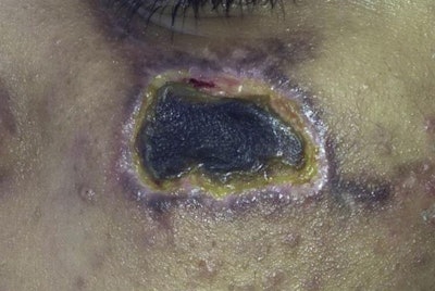 The girl's skin when she arrived at the endodontic department at the dental center.