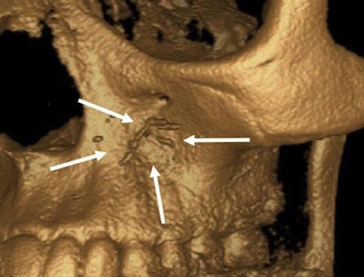 A 3D reconstruction of a cone-beam computed tomography (CBCT) scan shows contrast material in the route of the infraorbital artery. All images courtesy of Al-sheeb et al. Licensed under CC BY 4.0.
