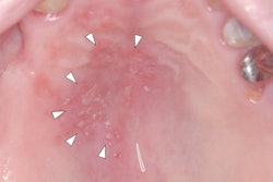 2021 11 12 23 27 6291 2021 11 12 Pfizer Bio N Tech Herpes 400