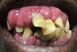 2021 11 17 01 20 5869 2021 11 17 Gingival Overgrowth 20211117012641