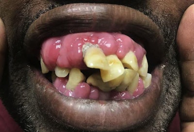 The patient showing amlodipine-induced gingival overgrowth. Image courtesy of Portnoy et al. Licensed by CC BY 4.0.