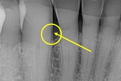 2021 11 18 01 39 6107 2021 11 18 Danenberg Tooth Xray 20211118013529