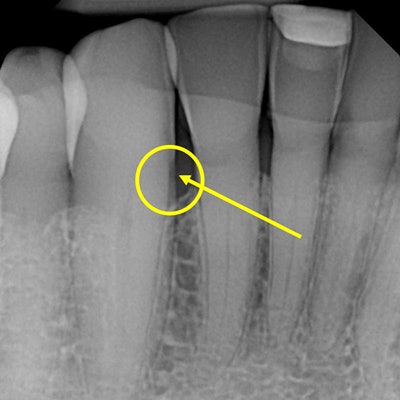 2021 11 18 01 39 6107 2021 11 18 Danenberg Tooth Xray 20211118013529