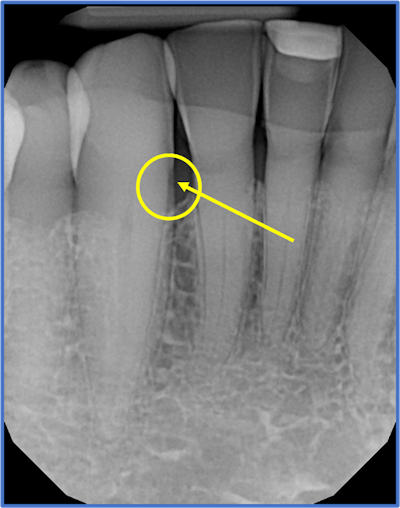A dental x-ray showing root decay on the mesial of #27. Image courtesy of Dr. Alvin Danenberg.