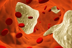 2021 11 18 22 45 6819 Atherosclerosis Clot 400