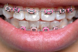 2018 09 28 18 50 4194 Braces Pink Bands 400