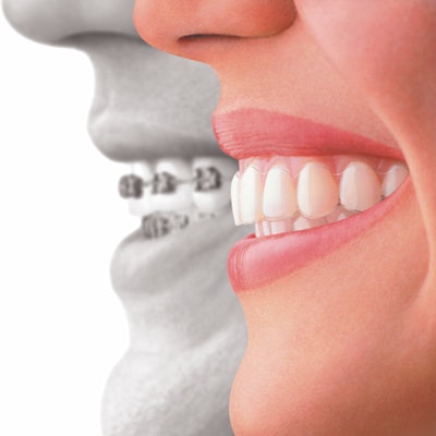 2019 06 14 17 16 9356 Invisalign 400