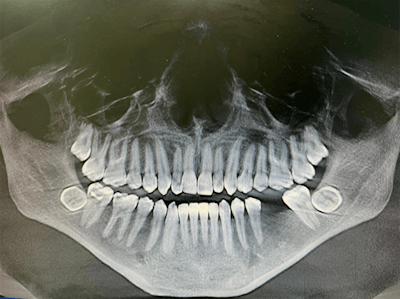 Panoramic screening radiograph shows bilateral impacted mandibular third molars. All images courtesy of Kolarkodi et al. Licensed by CC BY 4.0
