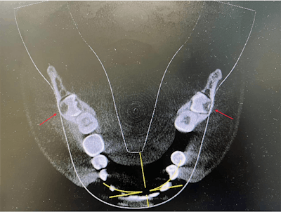 Axial CBCT shows incompletely formed roots and the impacted teeth horizontally situated in linguobuccal direction.