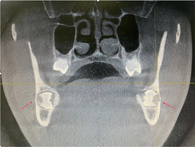 Sagittal CBCT shows the bilateral symmetrically impacted teeth.