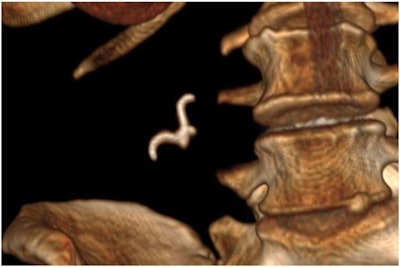 3D CT reconstruction shows a hook-shaped object, which turned out to be the woman's dentures.