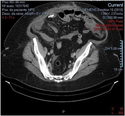 CT scan shows a dense metallic object located in the small bowel in the right lateral quadrant with free fluid and localized fat thickening. All images courtesy of Salvador et al. Licensed under CC BY 4.0.