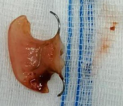 The patient's surgically removed partial denture.